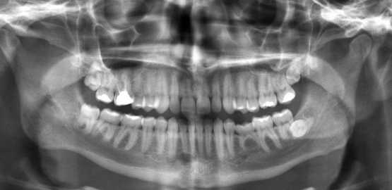 Un estudio refuerza la teoría sobre el origen del Alzhéimer: una infección en la boca